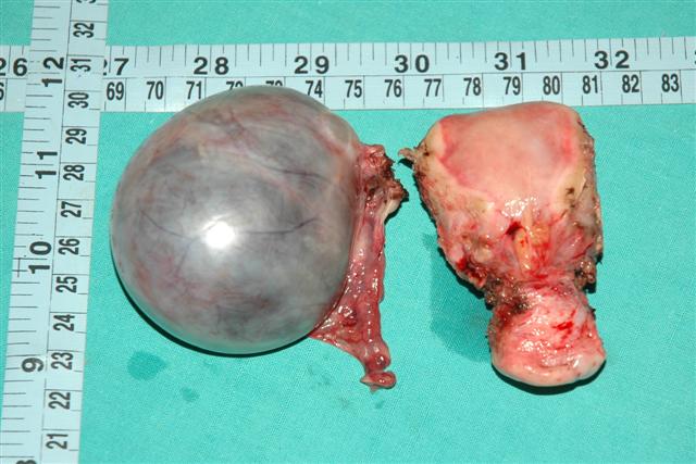 Right side ovarian cyst ,tube with uterus